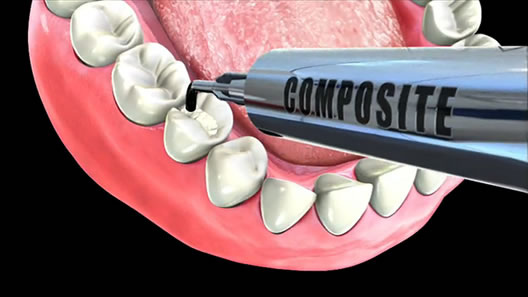Dental Composite Resin bangalore